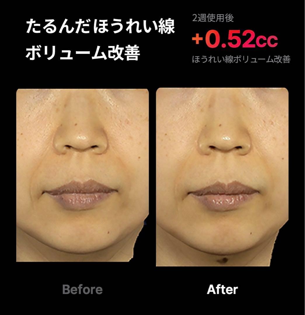 メディキューブ medicube AGE-R ハイフォーカスショット 美顔器