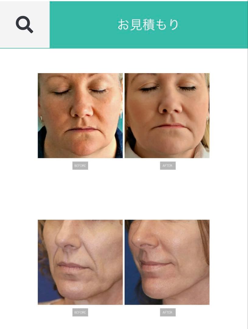 RF美顔器　高周波美顔器 リフトアップ 強力35Wエレクトロポレーション