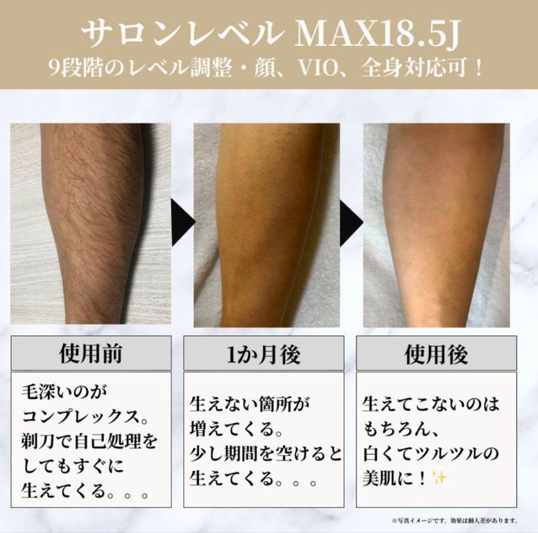 Remozer IPL脱毛器 99,999回照射