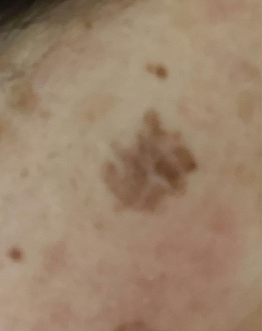 ✨️低周波顔シミ取りエステ✨️人気商品✨️即日発送