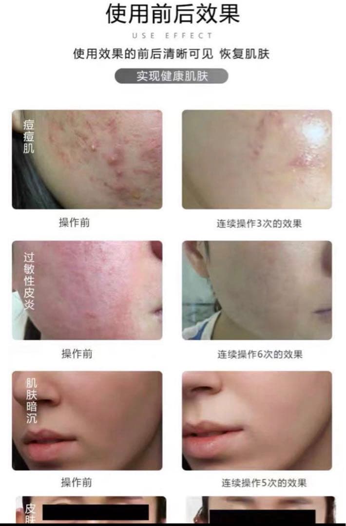 最新版　プラズマペン　繰り返すニキビ肌に　肌荒れに　業務用・セルフok