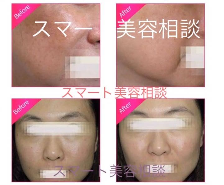 フェイシャル LEDライト RF 肌引き締め 若返り 美容機器 キャビテーション