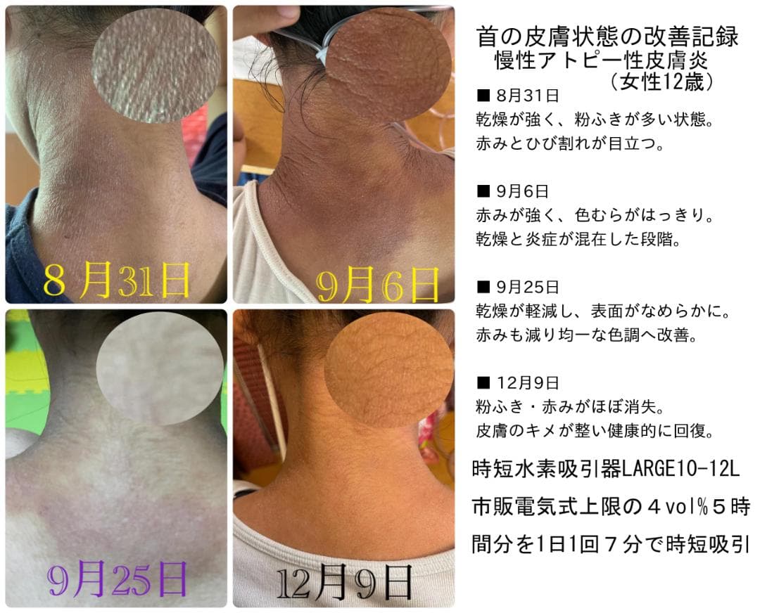 高速時短水素吸引・どこでも使える・1回で水素水の120万倍　水素付セットモデル