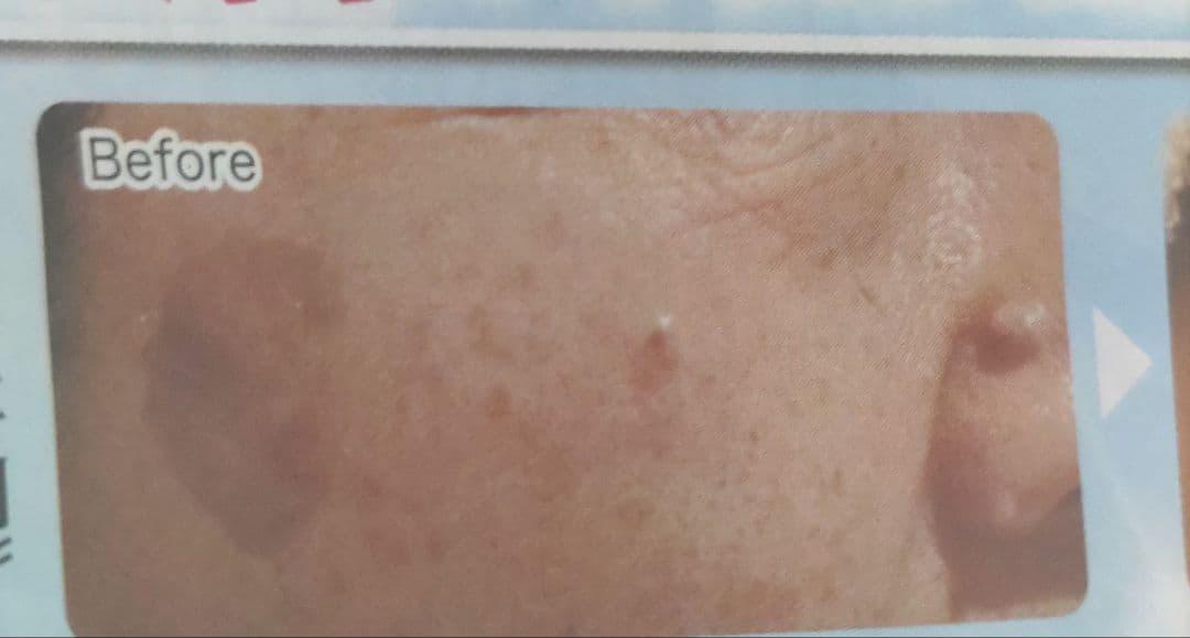 ✨️最新型新品低周波顔シミ取りエステ✨️残りわずか！！