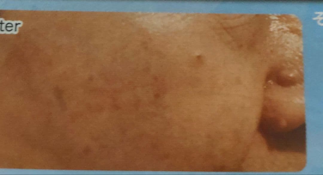 ✨️最新型新品低周波顔シミ取りエステ✨️残りわずか！！