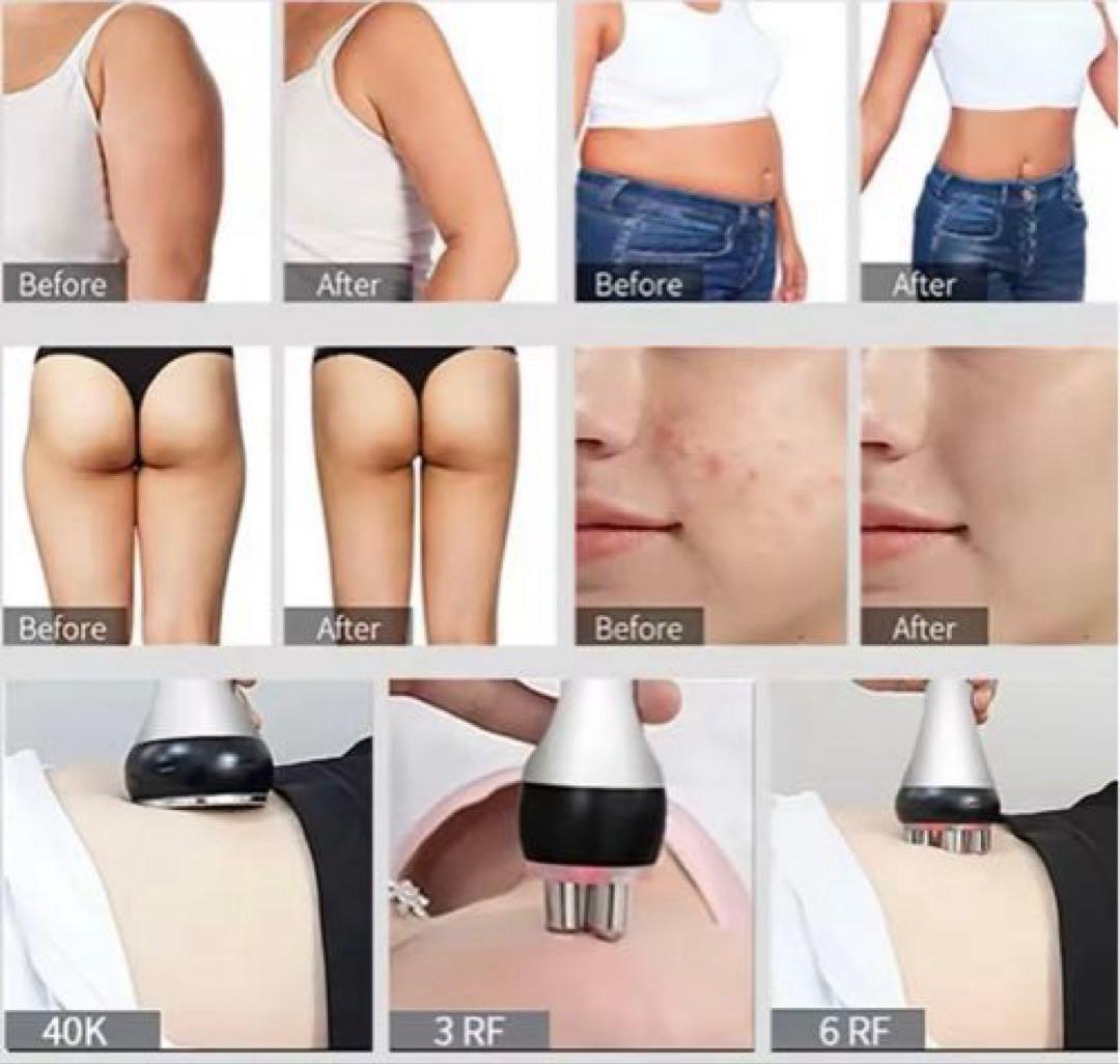 在庫一掃セール【激安】Mini3in1 業務用レベル　キャビテーション　ラジオ波