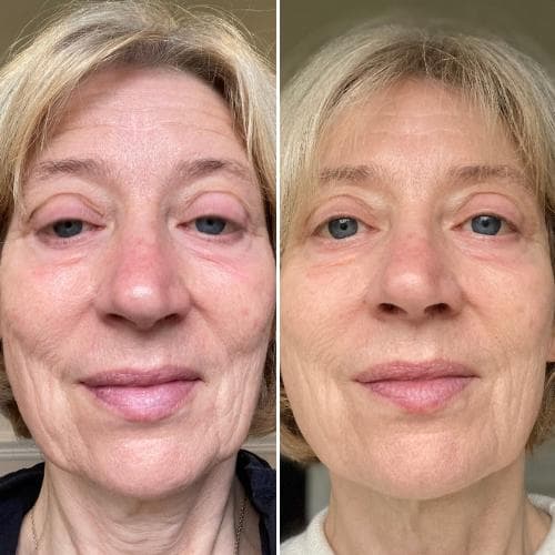 LEDライトセラピーマスク シリーズ2