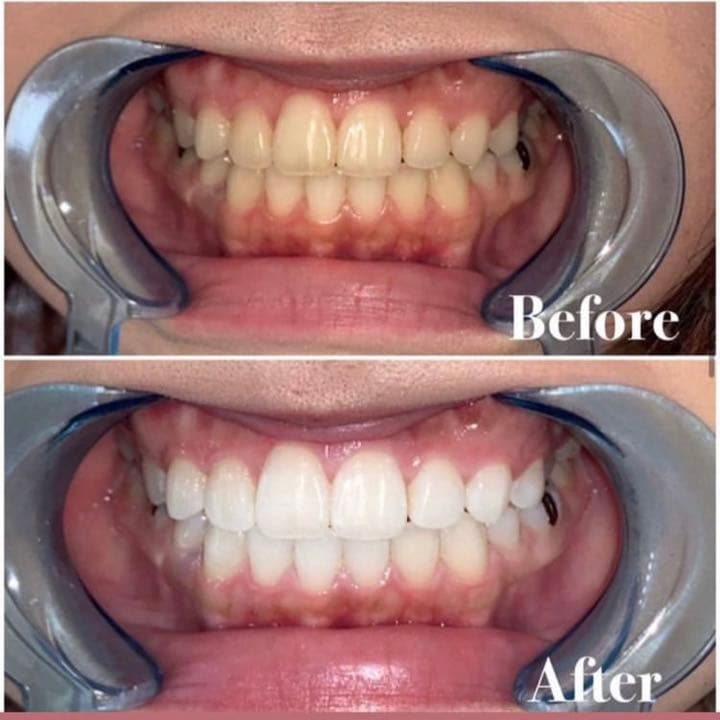 【ホワイトニングマシン】シャリオン　定価120万円