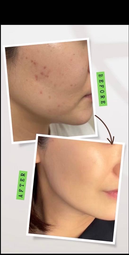 【12月31日まで年末セール】剥離ありハーブピーリング10回分