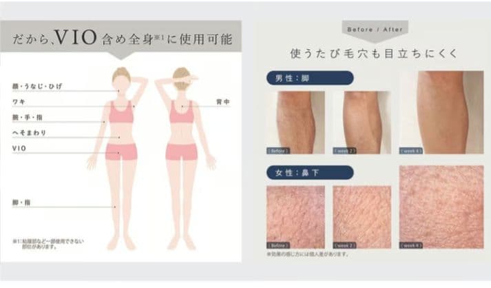 【新品未使用】LINKA リンカ フレアタッチプロ 光脱毛器