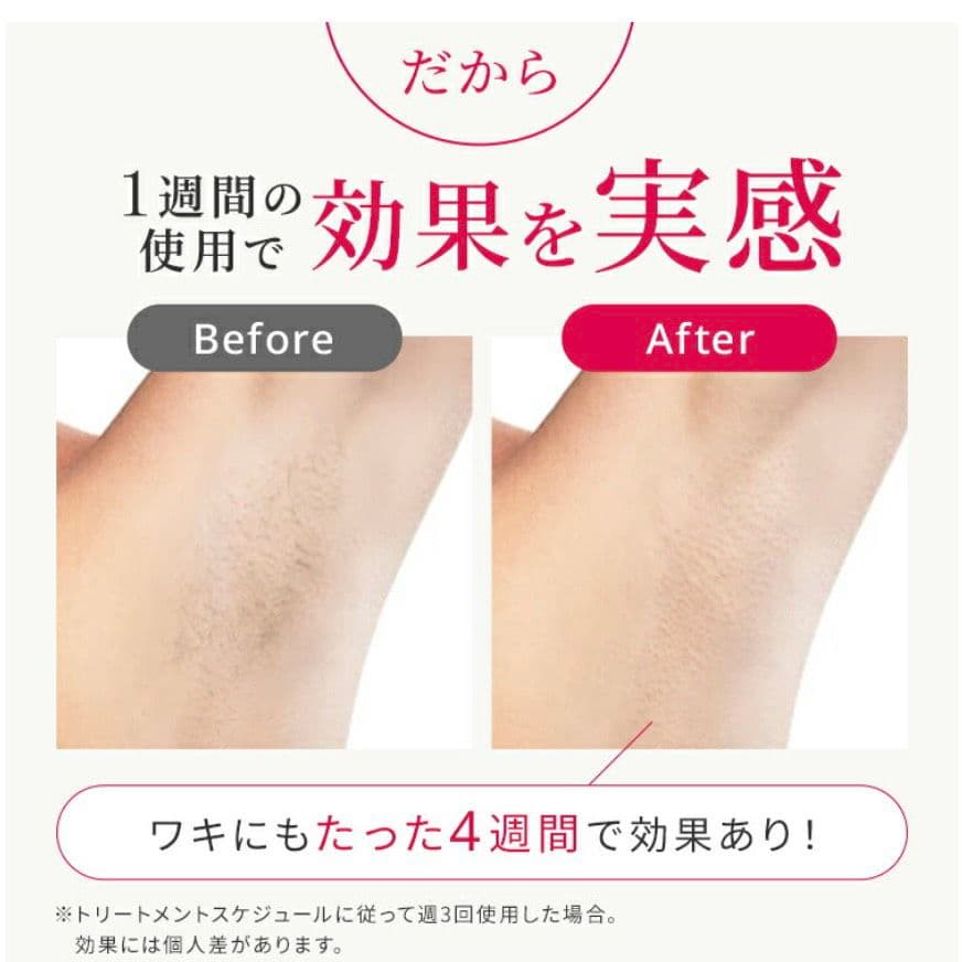 正規品　Ulike 脱毛器 Air10 光美容器　新品未使用未開封