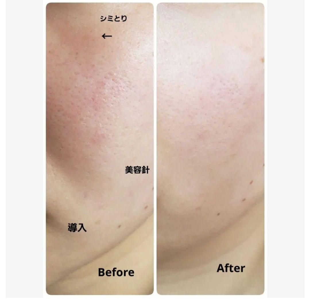 Pignet 美顔器■電気美容針/シミとり/導入