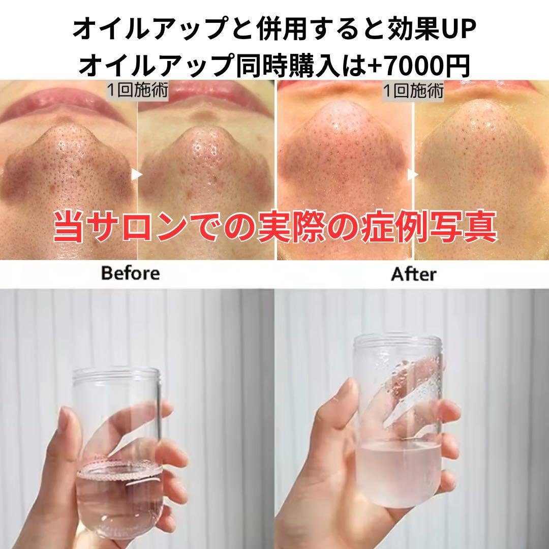 akkky【毛穴洗浄マシン+オイルアップ+カウンセリングツール】セット