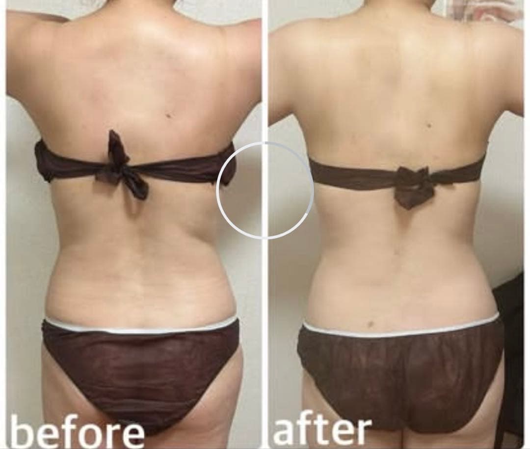 ラジオ派キャビテーション業務用痩身機械(値下げ中)