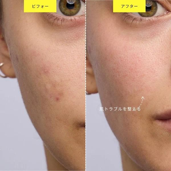 ZIIP DOT (ハイテク美顔器)