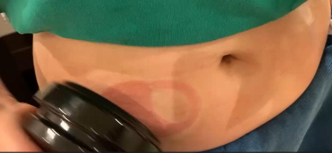 【最終値下】SUPER CELLULITE セルライトマシン