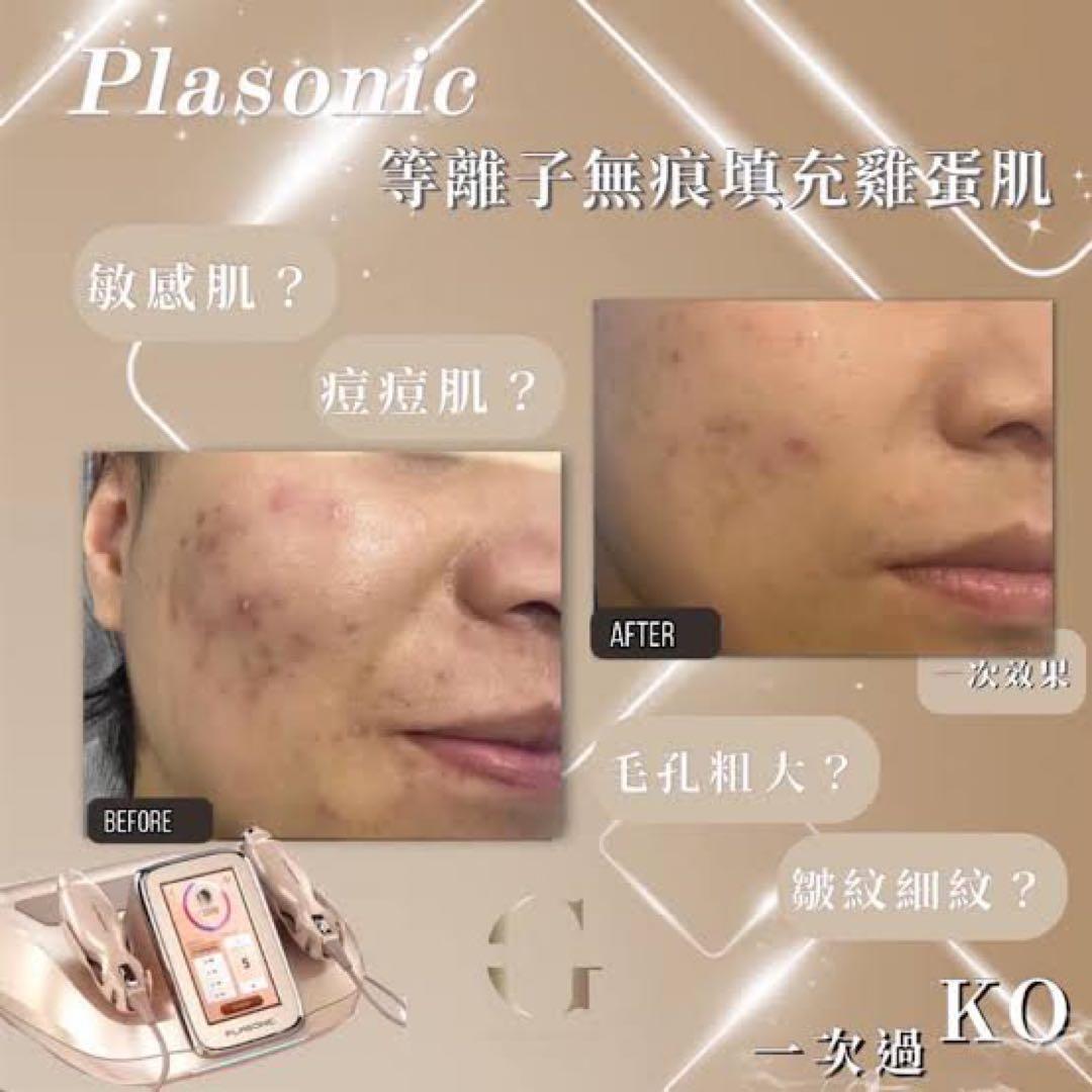 プラズマ plasma 美容　シミ　肝斑　ニキビ　LDM エレクトロポレーション